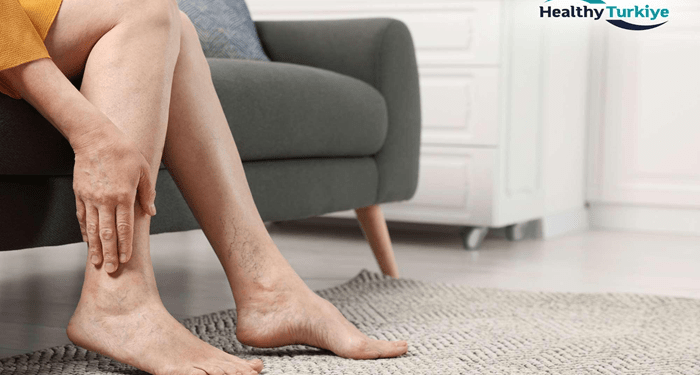 Surgical vs Non-Surgical Treatments for Chronic Venous Insufficiency in Turkey